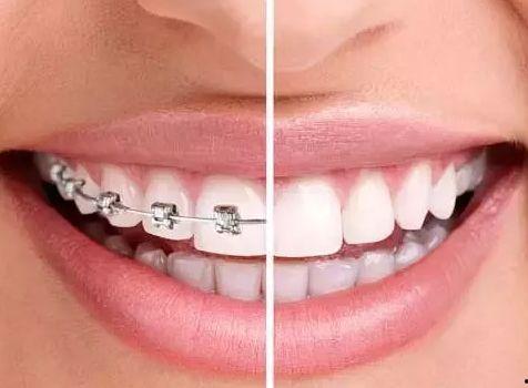 国产阴影矫正牙齿视频,揭秘牙齿阴影矫正的神奇效果